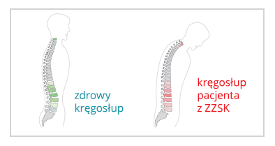 Grafika przedstawia prawidłowy kręgosłup oraz zdeformowany u pacjenta cierpiącego na zesztywniające zapalenie stawów kręgosłupa.